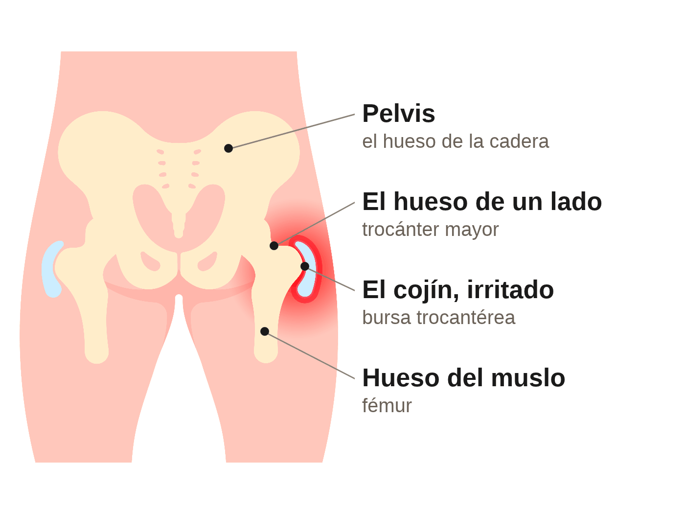 Ilustración de la pelvis y las dos caderas vistas de frente. Se señalan la pelvis, el hueso de la cadera; el hueso de un lado, que es el trocánter mayor; el cojín irritado, que es la bursa trocantérea, marcado en rojo; y el hueso del muslo, el fémur.